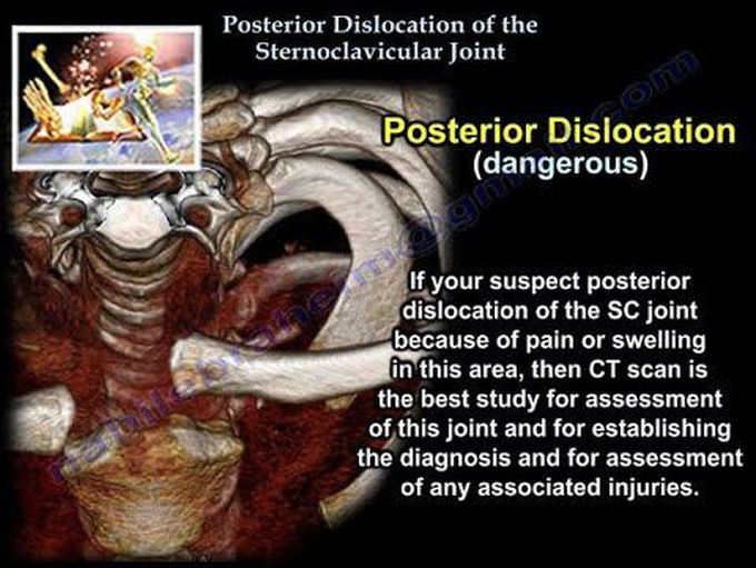 Posterior Dislocation Sternoclavicular Joint  - Everything You Need To Know - Dr. Nabil Ebraheim
