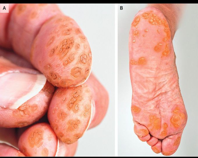 Palmoplantar Papules