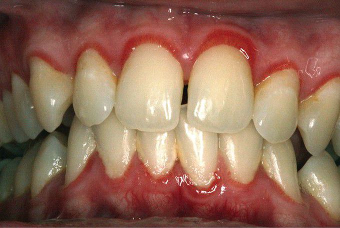 Marginal Gingivitis