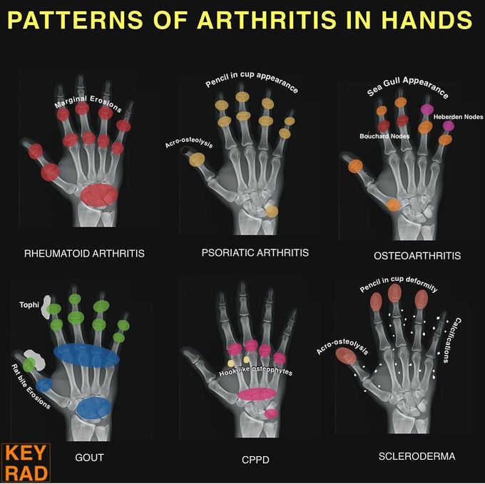 Patterns of Arthritis