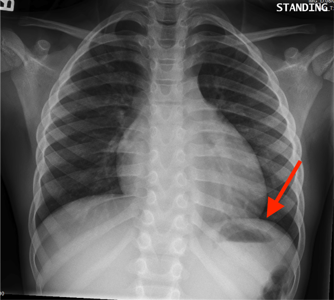 What's the part marked on the CXR?