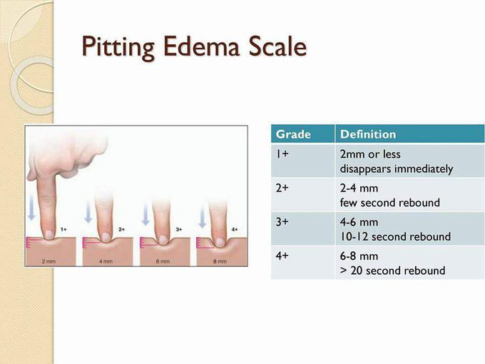 Pitting Edema Scale - MEDizzy