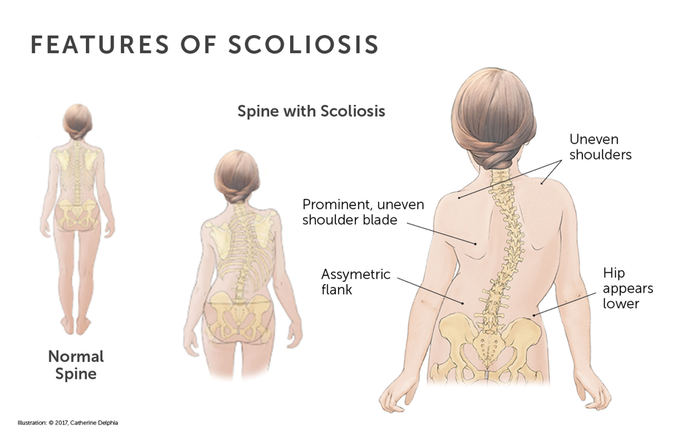 congenital scoliosis