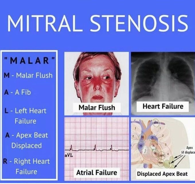 Mitral Stenosis