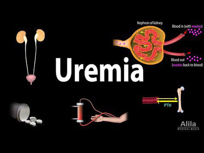 Kidney Diseases VIII-
Uremia (Animation)