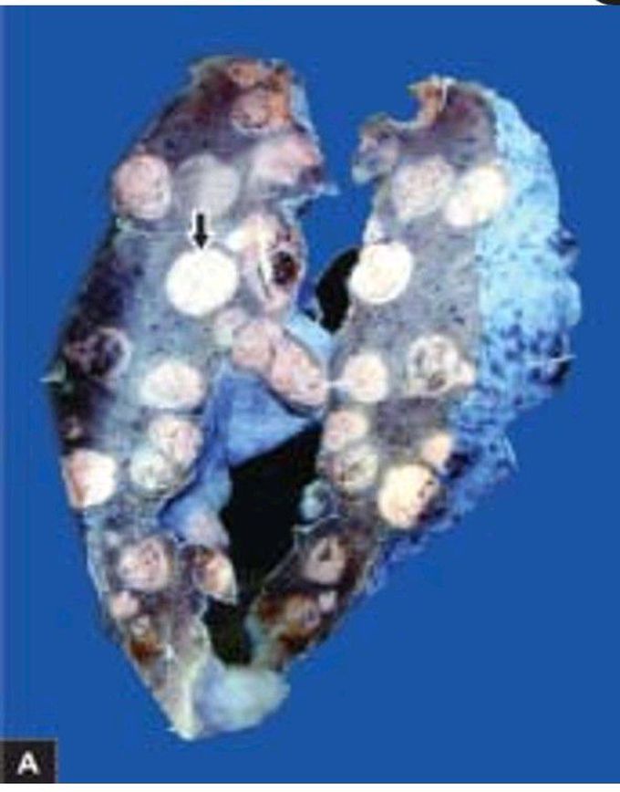 Metastatic sarcoma lung.