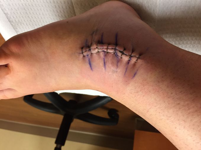 Scar from a Brostrom procedure to repair a failed ankle reconstruction.