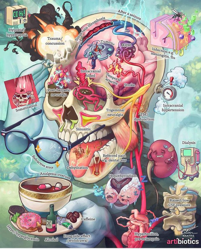 Causes of headache