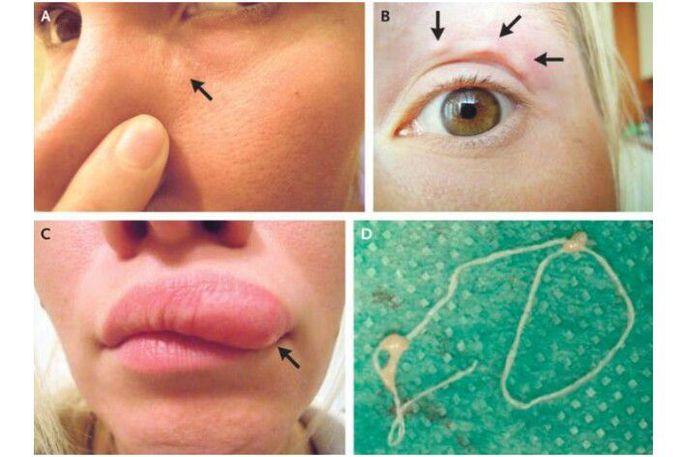 An odd lump on a woman's face turned out to be a worm