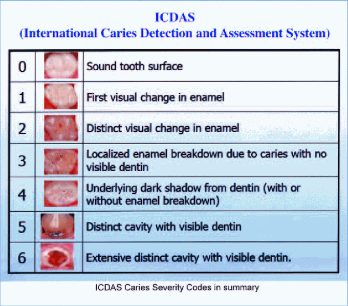 ICDAS