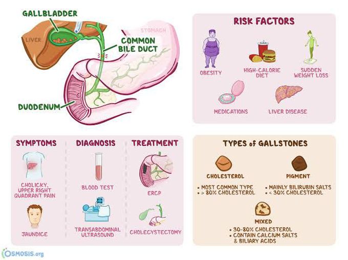 Treatment of choledocholithiasis