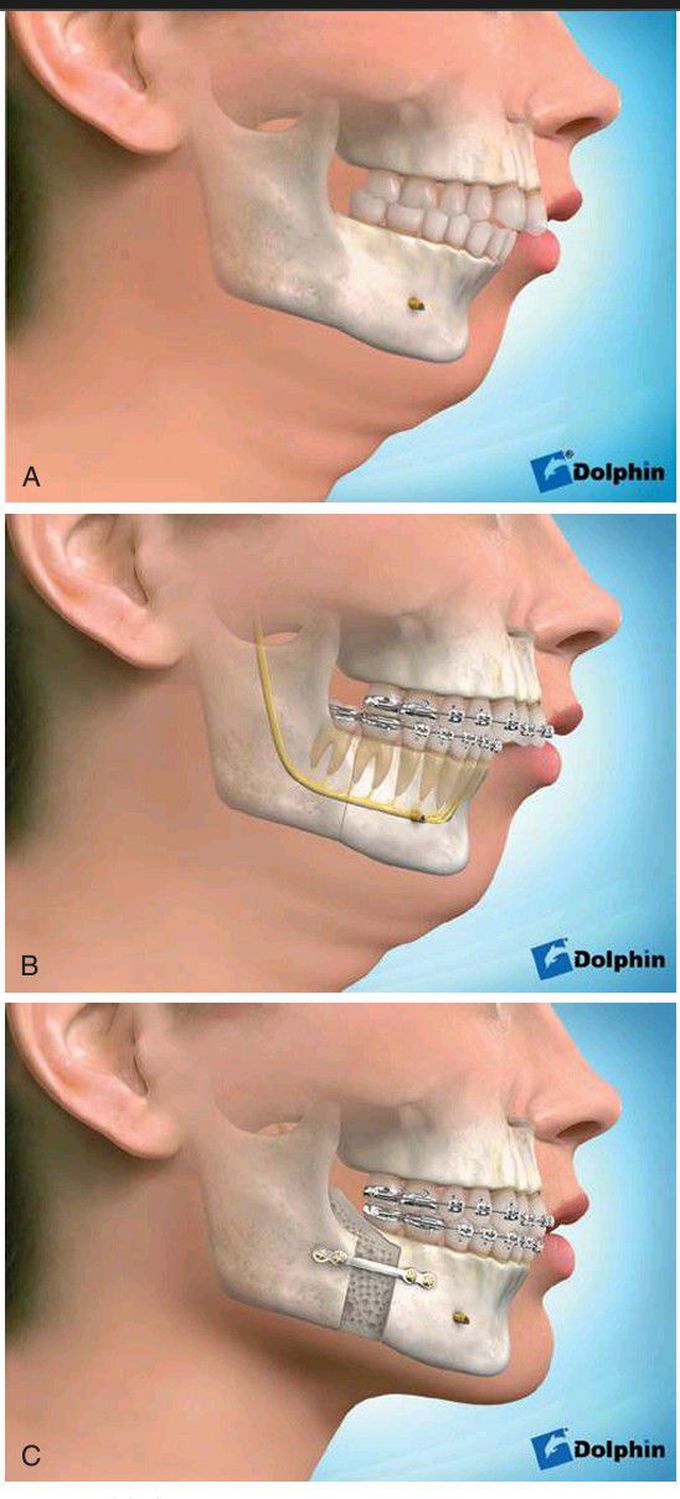 Class II malocclusion treatment