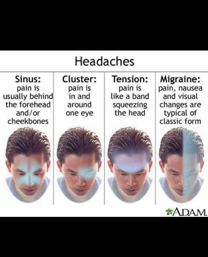 Types of headaches.