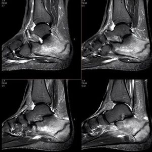 Musculoskeletal MRI. Calcaneus fracture. - MEDizzy