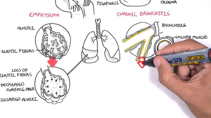 Introduction to Chronic Obstructive Pulmonary Disease (COPD)