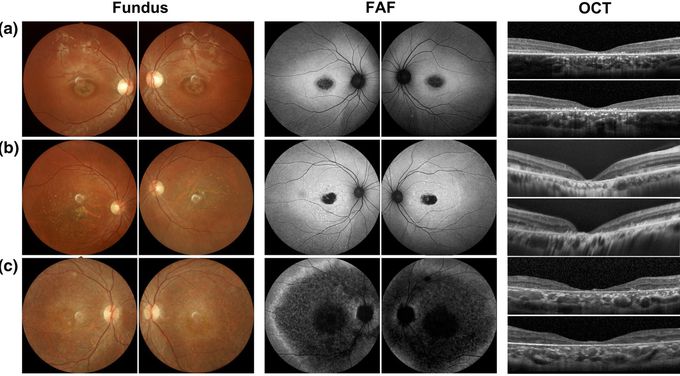 Stargardt’s Disease: A Visual Disability