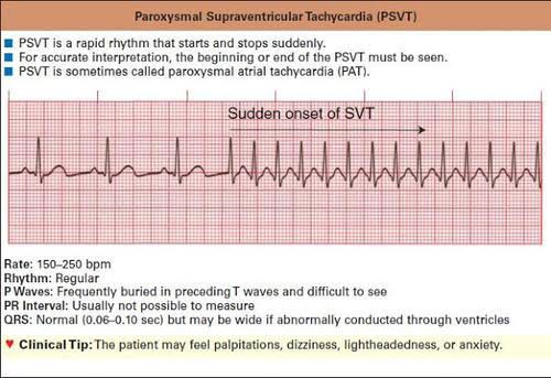 Paroxysmal Supraventricular Tachycardia Paroxysmal Supraventricular