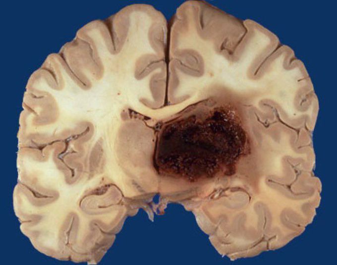 Basal ganglia hemorrhage