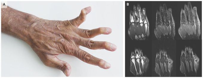 Jaccoud’s Arthropathy