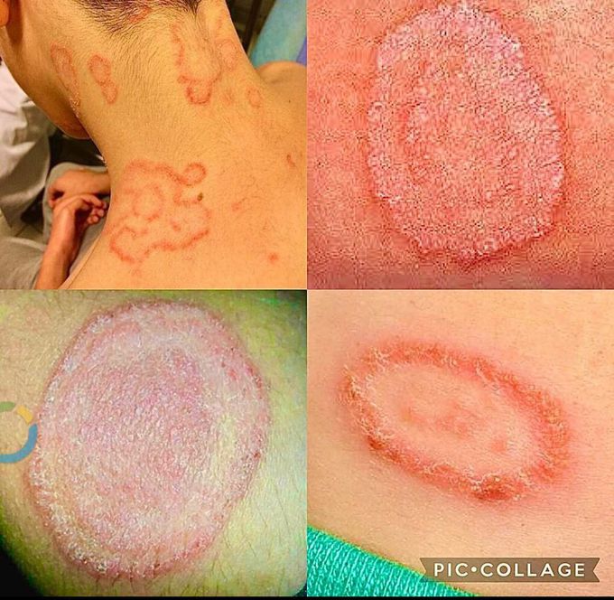 Tinea Corporis Medizzy