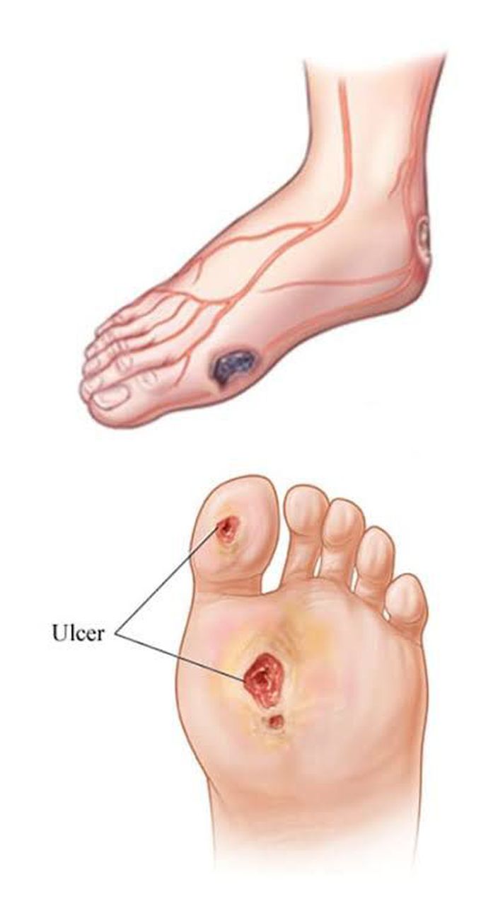 Arterial ulcers treatment