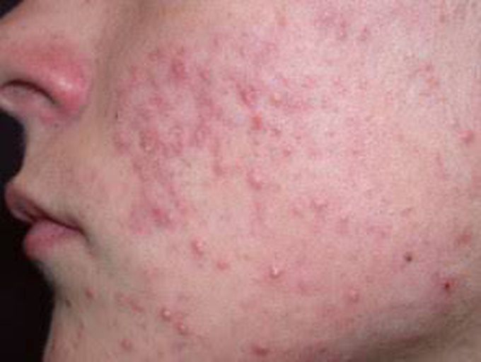 Acne Vulgaris