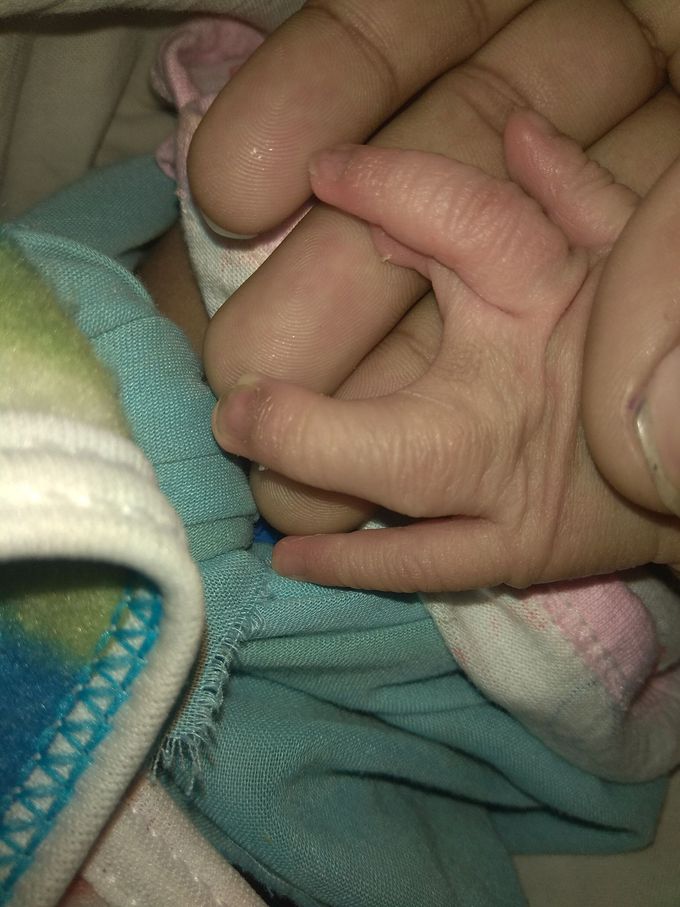 Diagnosis of this hypoplasia