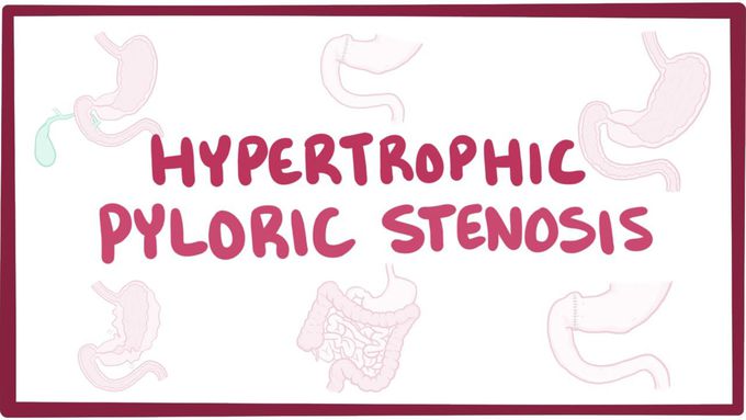 Congenital Hypertrophic Pyloric Stenosis