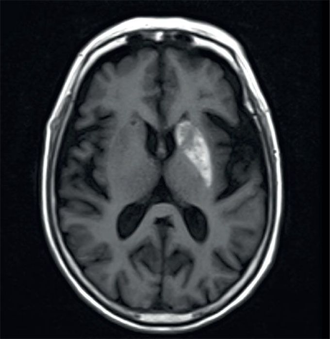 Involuntary choreiform movements in a diabetic patient