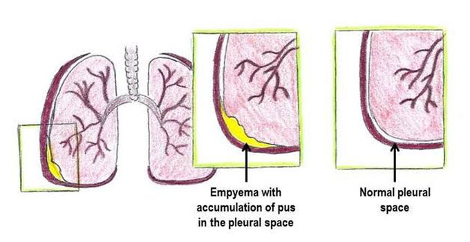 Empyema