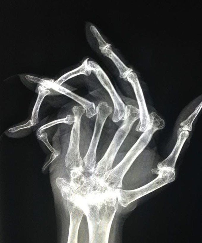 X-Ray of a hand with advanced rheumatoid arthiritis