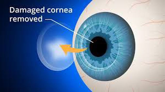 Corneal transplant