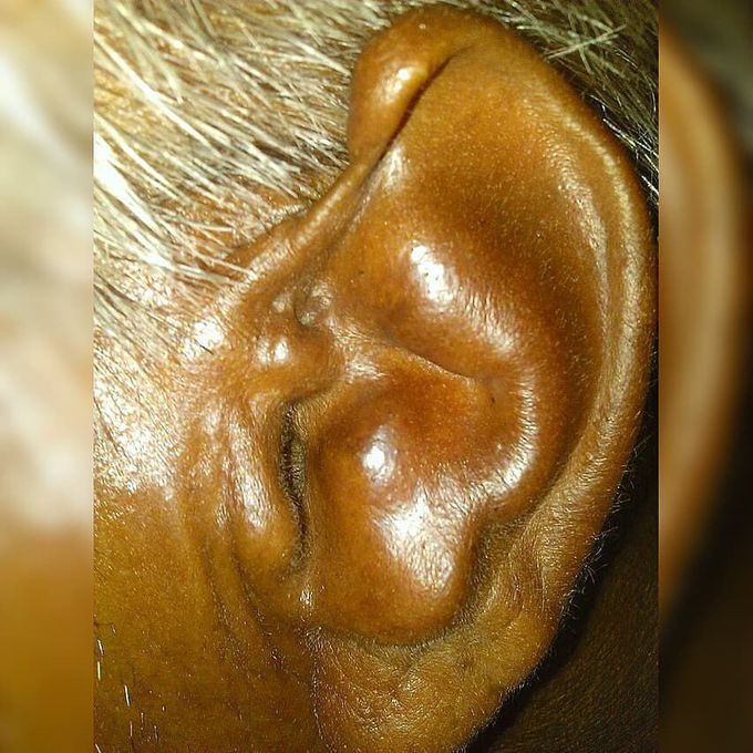 cauliflower ear