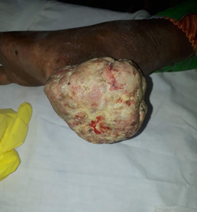 Lift calcaneum