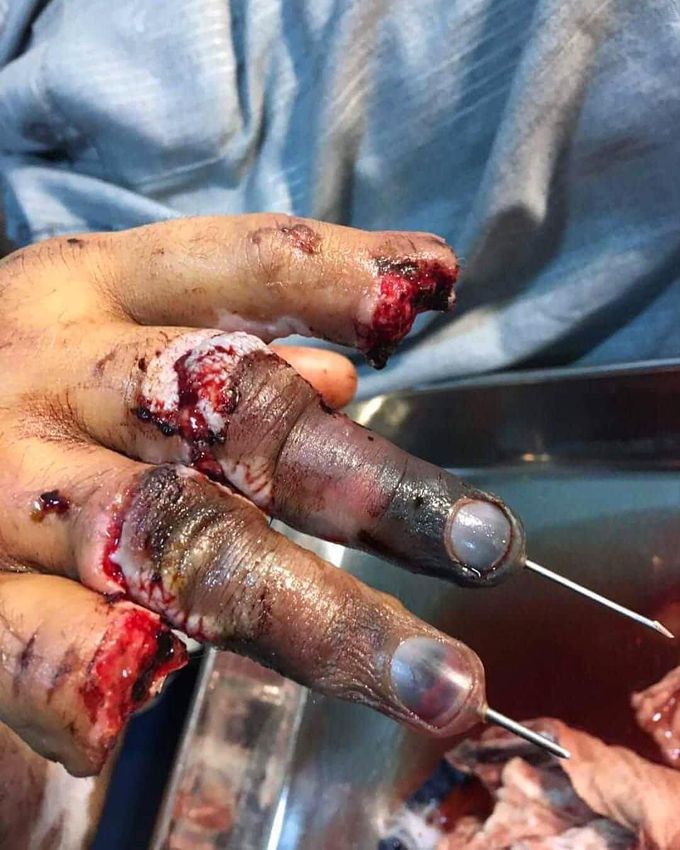 Reattaching and realigning the digits using nails after he got his fingers chopped off on a work place accident!!