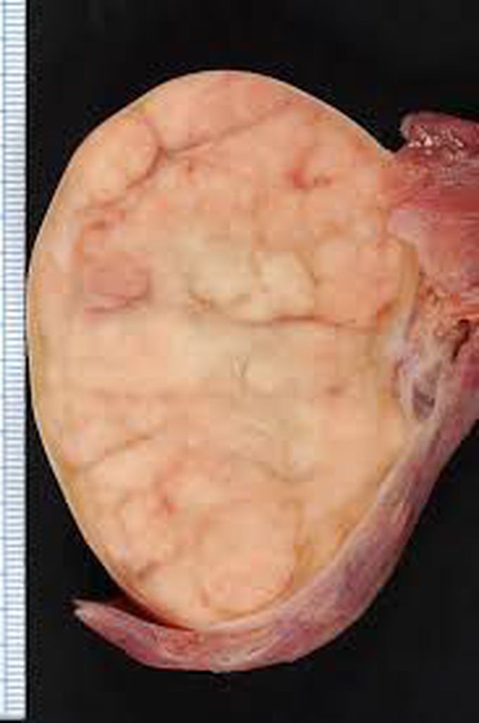 Testicular Seminoma