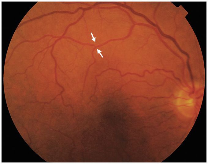 Amaurosis Fugax Caused by a Branch Retinal Artery Embolus