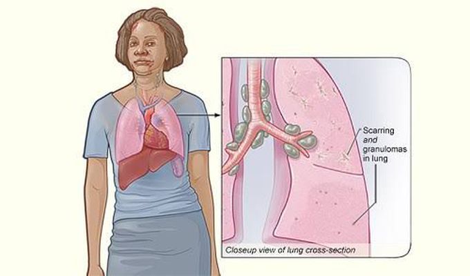 causes of sarcoidosis