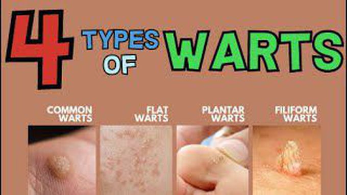 Types of Warts