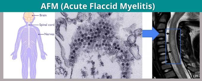 Acute Flaccid Myelitis