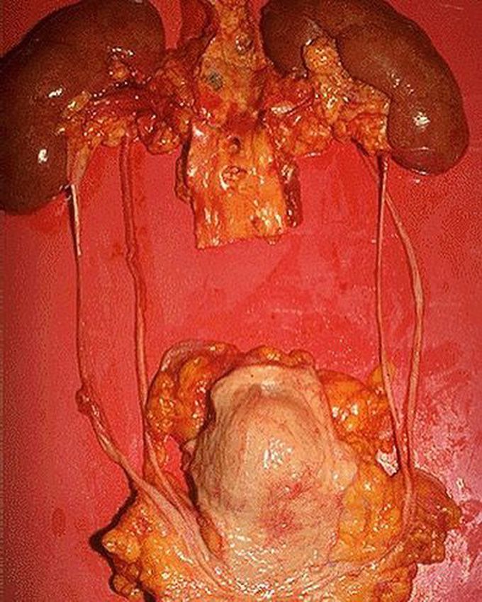 Duplicated ureter!
