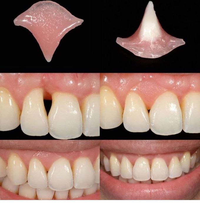 Removable Partial Denture