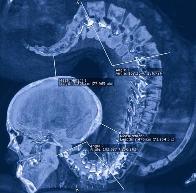 X-ray of a contortionist girl