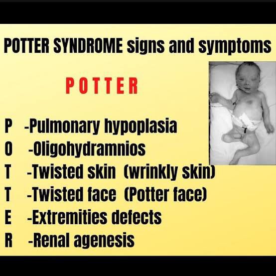 oligohydramnios potters syndrome