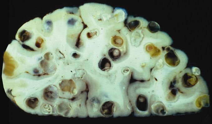 Neurocysticercosis