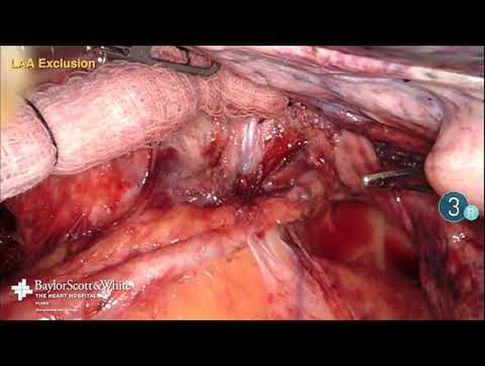Robotic-Assisted Left Atrial Appendage Exclusion with the PRO•V AtriCure Atrial Clip