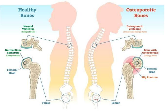 Osteoporosis