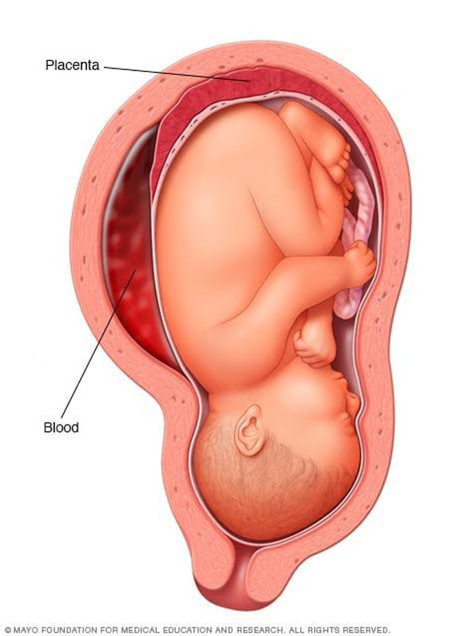 Abruption placenta