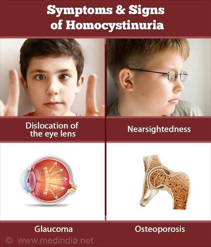 Homocystinuria