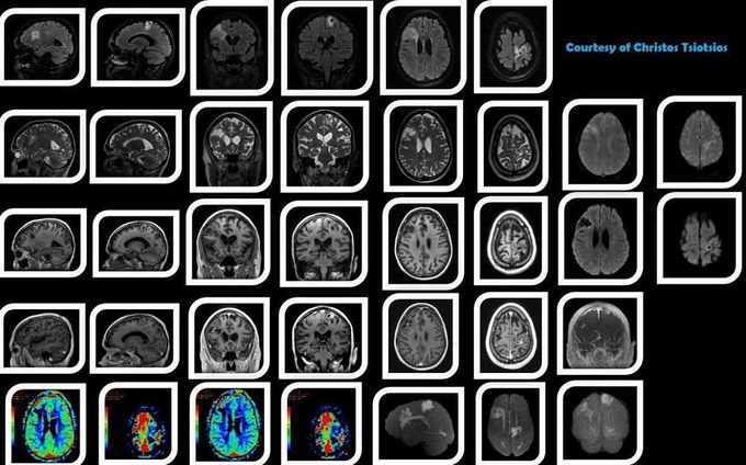 MR Imaging of brain metastases
